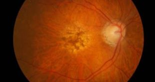 Το brolucizuma ης Novartis αποδεικνύει τρίμηνη αξιοπιστία για την νεοαγγειακή ηλικιακή εκφύλιση της ωχράς κηλίδας