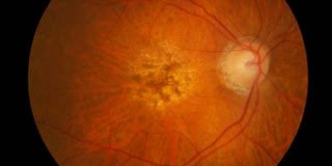 Το brolucizuma ης Novartis αποδεικνύει τρίμηνη αξιοπιστία για την νεοαγγειακή ηλικιακή εκφύλιση της ωχράς κηλίδας