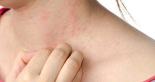 Αλλεργίες και αλλεργικό εξάνθημα του καλοκαιριού. Που οφείλονται και πώς αντιμετωπίζονται;