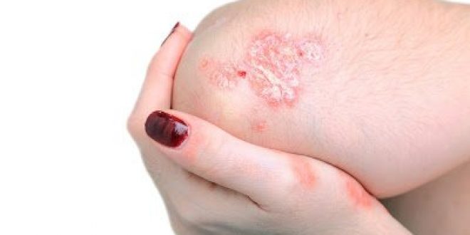 Μέσα από 10 απλές ερωτήσεις μπορείς να υπολογίσεις σε ποιο βαθμό η ψωρίαση έχει επηρεάσει την καθημερινότητά σου