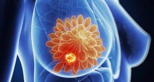 Το φάρμακο pertuzumab πήρε έγκριση για τον καρκίνο του μαστού