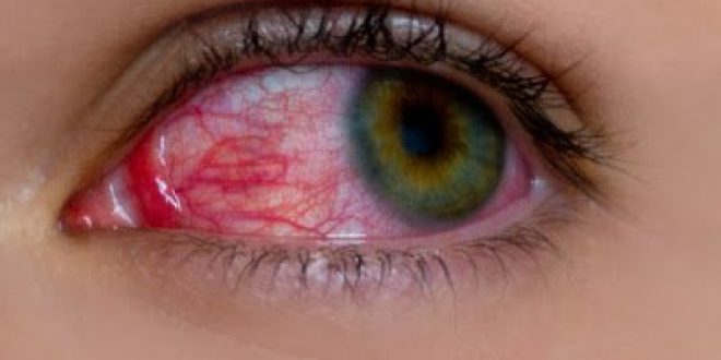 Αίμα στο μάτι από σπασμένα αιμοφόρα αγγεία (υπόσφαγμα)